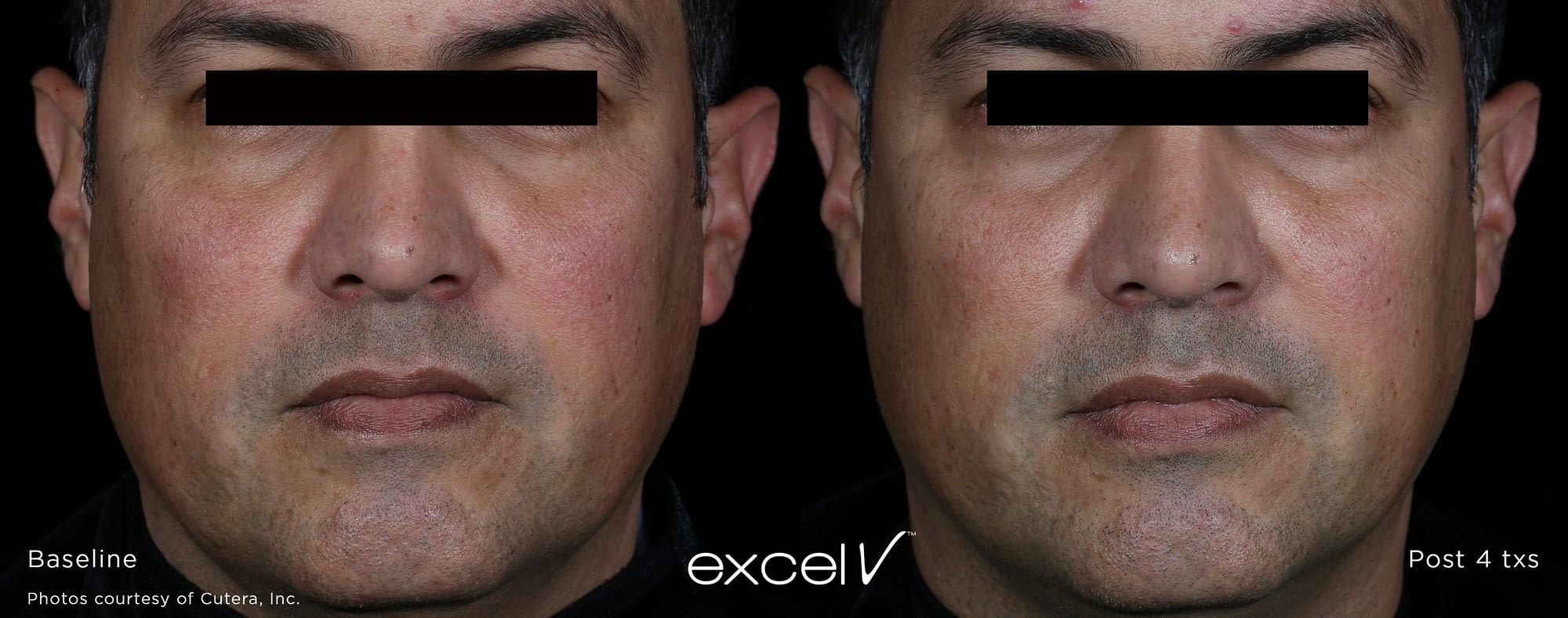 xeo LaserGenesis before and after photo