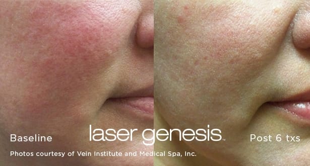 xeo LaserGenesis before and after photo