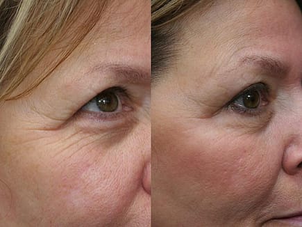 crows feet botox before and after