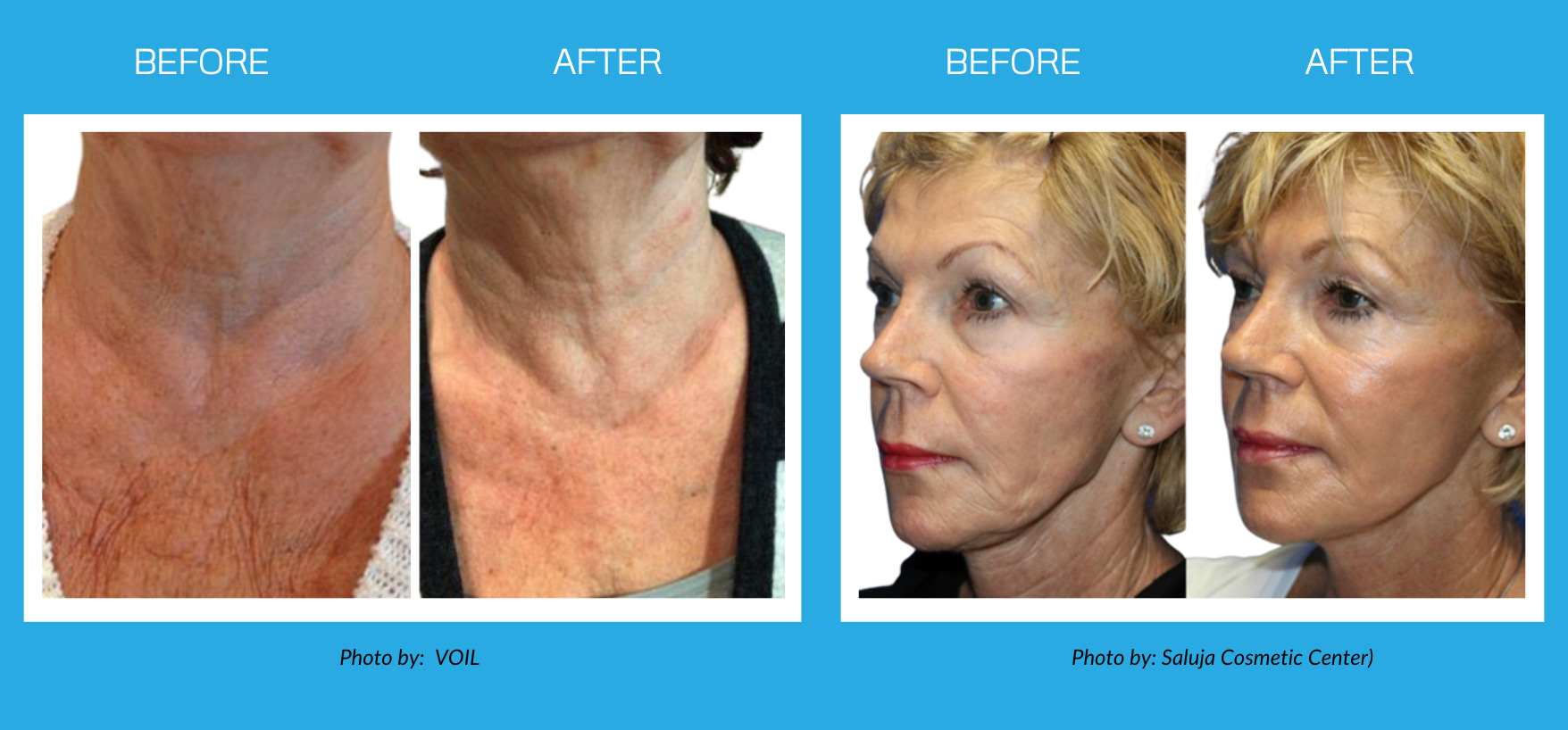 before after of RF microneedling on face and neck