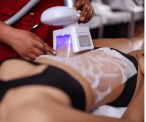 Woman getting a coolsculpting treatment on the tummy