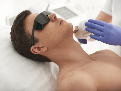 man laser hair removal on face