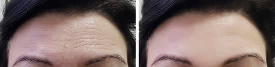 forehead lines botox treatment