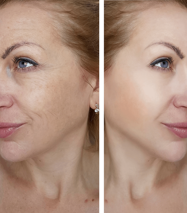 before and after comparison of a woman's face with wrinkled and tight skin.