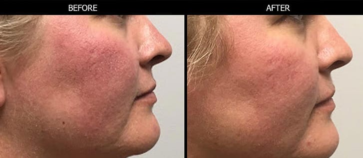 IPL™ photofacial before and after photo