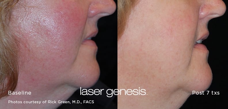 Laser Genesis Skin Rejuvenation treatment  near you in Gilbert, Arizona